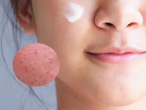 A酸暗瘡膏使用方式